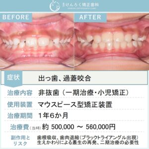 ９歳女子：小児のマウスピース矯正で永久歯萌出スペースの確保と過蓋咬合を改善したケ－ス
