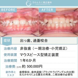 ９歳女子：小児のマウスピース矯正で永久歯萌出スペースの確保と過蓋咬合を改善したケ－ス