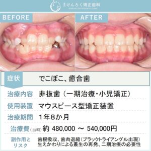 ９歳女子：叢生を改善しつつ右下の癒合歯を含めて永久歯列を想定して咬合誘導したケース