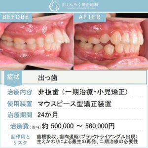 ８歳女子：永久歯萌出スペース獲得と上顎前突（出っ歯）を小児のマウスピース矯正で治したケース