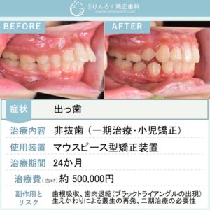 ８歳女子：永久歯萌出スペース獲得と上顎前突（出っ歯）を小児のマウスピース矯正で治したケース