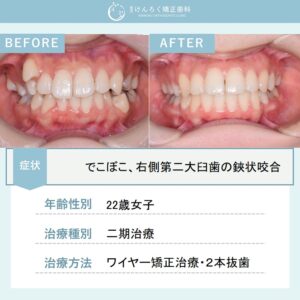 欠損歯があるなかで遠心移動と抜歯をあわせて叢生を改善した事例