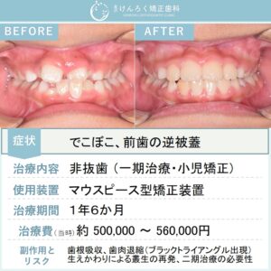 ８歳男子：小児矯正で前歯のでこぼこ（中切歯の逆被蓋あり）をワイヤー矯正で治したケース