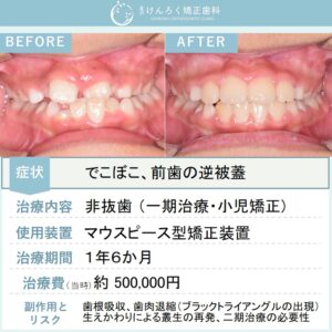 ８歳男子：小児矯正で前歯のでこぼこ（中切歯の逆被蓋あり）をワイヤー矯正で治したケース