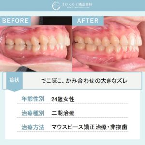 マウスピース矯正(インビザライン)にて上顎大臼歯の遠心移動を行い、叢生を非抜歯で治したケース