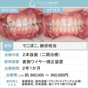 22歳女性：欠損歯があるなかで遠心移動と抜歯をあわせて叢生を改善した事例