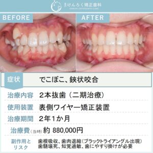 22歳女性：欠損歯があるなかで遠心移動と抜歯をあわせて叢生を改善した事例