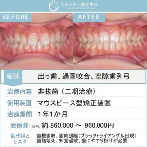 12歳女子：前歯のすきっぱと奥歯のずれをマウスピース型矯正装置（インビザライン）で治したケース