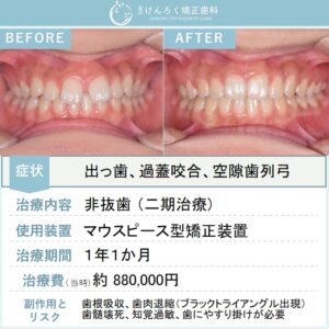 12歳女子：前歯のすきっぱと奥歯のずれをマウスピース型矯正装置（インビザライン）で治したケース