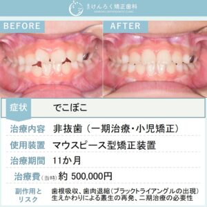 ８歳女子：前歯のでこぼこをお子さまのマウスピース矯正装置で治したケース