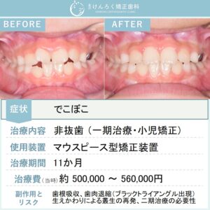 ８歳女子：前歯のでこぼこをお子さまのマウスピース矯正装置で治したケース