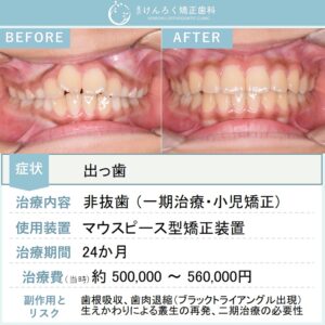 ９歳男子：永久歯萌出スペース獲得と上顎前突（出っ歯）を小児のマウスピース矯正で治したケース