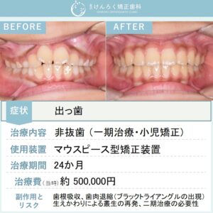 ９歳男子：永久歯萌出スペース獲得と上顎前突（出っ歯）を小児のマウスピース矯正で治したケース