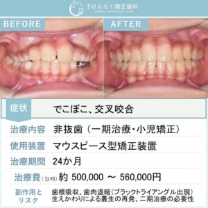 ９歳男子：永久歯萌出スペース獲得と歯列正中の是正を小児のマウスピース矯正で行ったケース