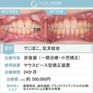 ９歳男子：永久歯萌出スペース獲得と歯列正中の是正を小児のマウスピース矯正で行ったケース