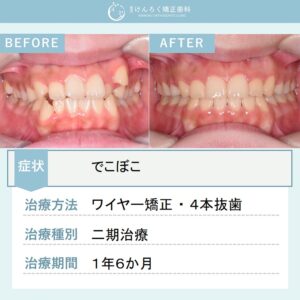 15歳女子：叢生を上下左右の第一小臼歯を４本抜歯して１年半という短期間で治したケース