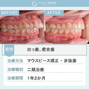 28歳女性：下顎前歯の先天性欠如を含む出っ歯をマウスピース矯正で治療したケース