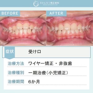 ９歳女子：受け口のお子さまをワイヤー矯正装置で６か月で治したケース