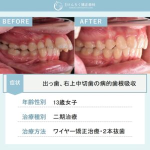 予後不良な前歯を抜歯してイレギュラーな排列で出っ歯を改善したケース