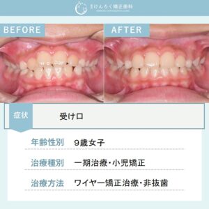 受け口のお子さまをワイヤー矯正装置で６か月で治したケース