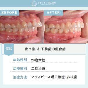 下顎前歯の先天性欠如を含む出っ歯をマウスピース矯正で治療したケース