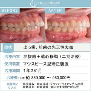 28歳女性：下顎前歯の先天性欠如を含む出っ歯をマウスピース矯正で治療したケース