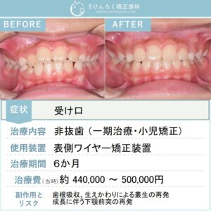 ９歳女子：受け口のお子さまをワイヤー矯正装置で６か月で治したケース