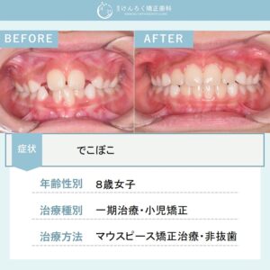 小児のマウスピース矯正でデコボコを改善したケース