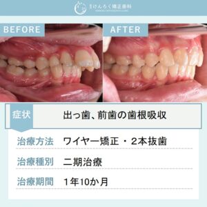 13歳女子：予後不良な前歯を抜歯してイレギュラーな排列で出っ歯を改善したケース