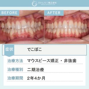 33歳女性：前歯のデコボコを上下顎遠心移動で歯を抜かないで治したケース