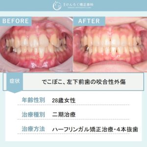 叢生と軽度の口ゴボを4本抜歯してハーフリンガルで治したケース