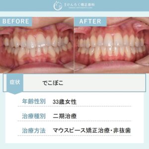 前歯のデコボコを上下顎遠心移動で歯を抜かないで治したケース