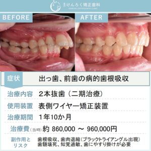 13歳女子：予後不良な前歯を抜歯してイレギュラーな排列で出っ歯を改善したケース