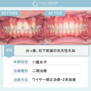 抜歯をして出っ歯を１年３か月で治したケース