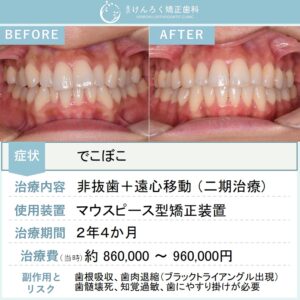 33歳女性：前歯のデコボコを上下顎遠心移動で歯を抜かないで治したケース