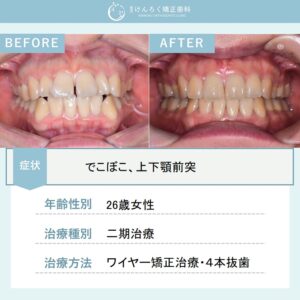 口の閉じにくさを上下顎小臼歯４本抜歯で改善したケース