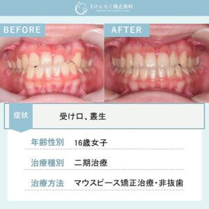 受け口をマウスピース矯正装置で歯を抜かずに改善したケース