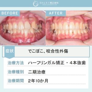 28歳女性：叢生と軽度の口ゴボを4本抜歯してハーフリンガルで治したケース