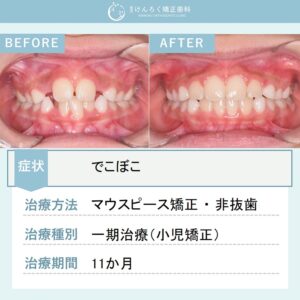 ８歳女子：小児のマウスピース矯正でデコボコを改善したケース