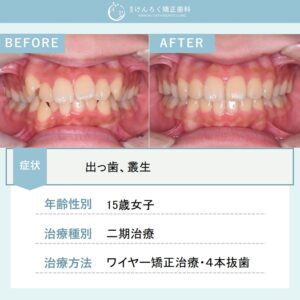 出っ歯を抜歯して１年５か月で治したケース