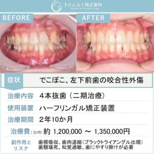 28歳女性：叢生と軽度の口ゴボを4本抜歯してハーフリンガルで治したケース
