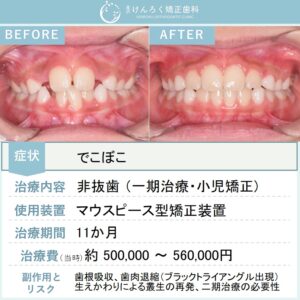 ８歳女子：小児のマウスピース矯正でデコボコを改善したケース
