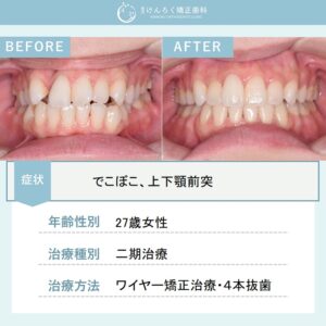引っ込んでいる歯と口の閉じにくさを４本抜歯で改善したケース