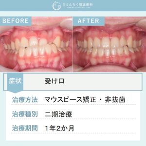 16歳女子：受け口をマウスピース矯正装置で歯を抜かずに改善したケース
