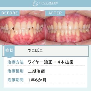 20歳男性：でこぼこを４本抜歯のワイヤー矯正で１年半で治した20歳男性のケース