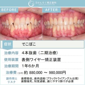 20歳男性：でこぼこを４本抜歯のワイヤー矯正で１年半で治した20歳男性のケース