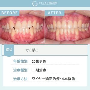 でこぼこを４本抜歯のワイヤー矯正で１年半で治した20歳男性のケース