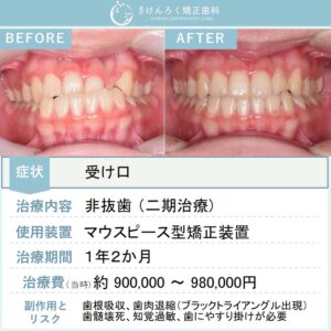 16歳女子：受け口をマウスピース矯正装置で歯を抜かずに改善したケース