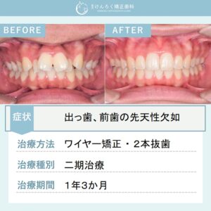 17歳女子：抜歯をして出っ歯を１年３か月で治したケース（先天性欠如あり)