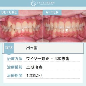 15歳女子：出っ歯を抜歯して１年５か月で治したケース